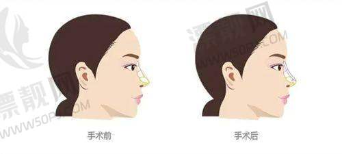 润澜玻尿酸的技术特性