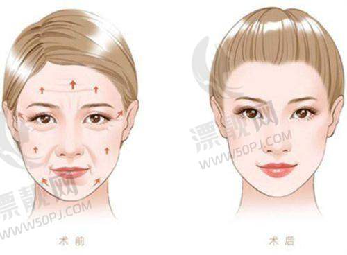 润澜玻尿酸属于什么档次的品牌？价格、技术、安全性等特性全解析！