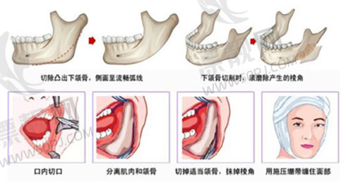 【眼袋分层狙击战】