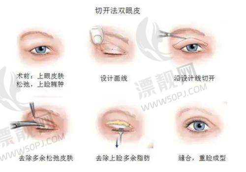 徐敦医生:自然灵动双眼皮手术的大师