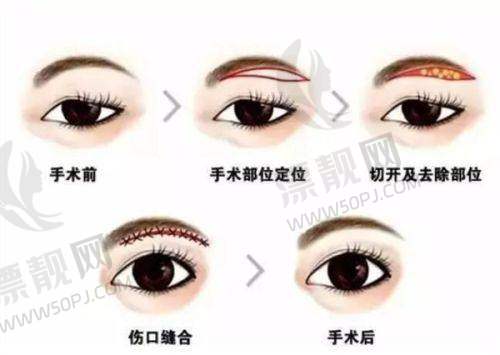 当双眼皮遇见整体美学