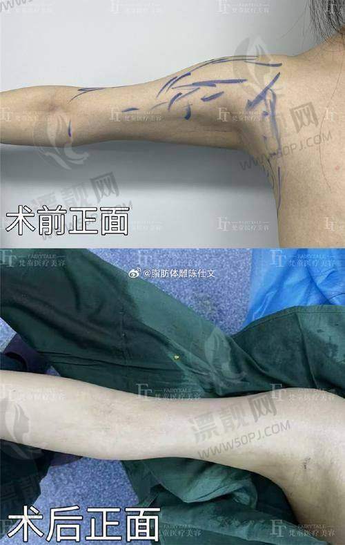 重庆军科医院吸脂项目价格参考