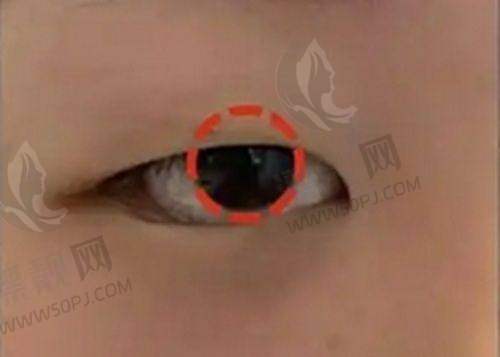 不开刀去眼袋:告别衰老疲惫感