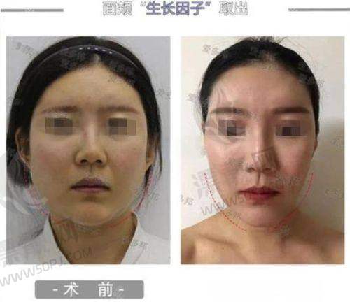精良技术为植发保驾护航