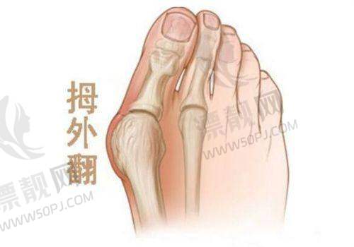 武汉眼周筋膜提升医院价格及适合人群对比