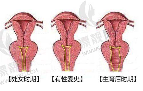 筋膜提升术后护理小妙招