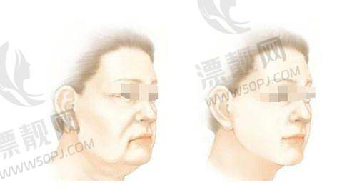 硅胶弹力线面部提升的适用人群