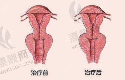 素妍骨胶原轮廓针的价格情况