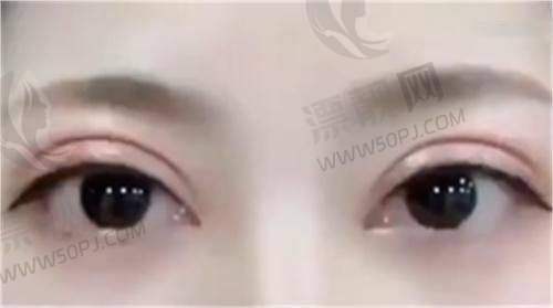 眼部整形