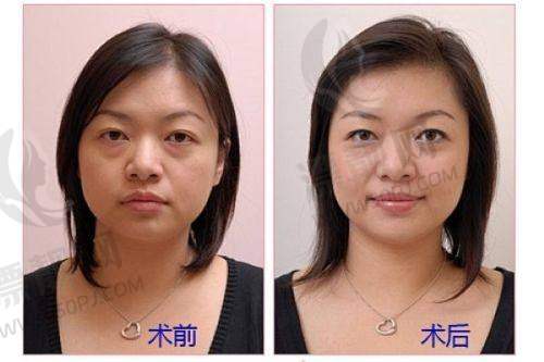 如何选择适合自己的玻尿酸产品