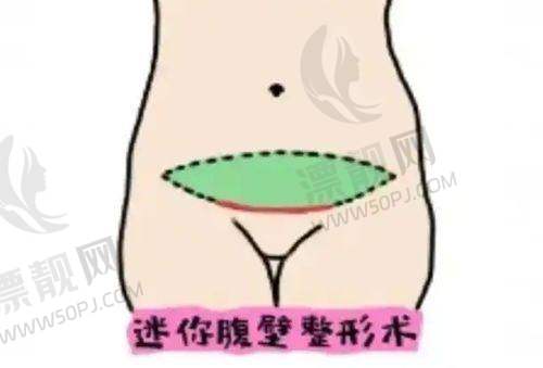 硅胶弹力线面部提升的成效如何?