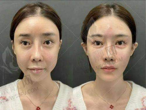 杨亚益医生双眼皮修复预约挂号指南：价格、案例与口碑全解析
