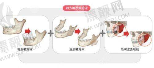 硅胶弹力线面部提升怎么样？安全吗、好用吗？能改善法令纹且效果持久吗？