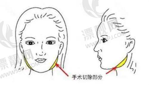 韩国来丽整形医院双眼皮修复复杂实例处理优势