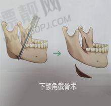 骨性填充热门之选,性价比凸显