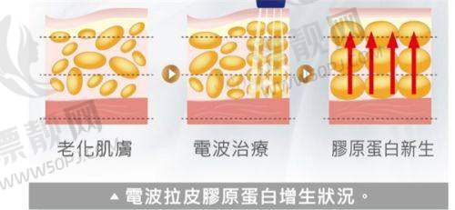 筋膜提升成效究竟咋样