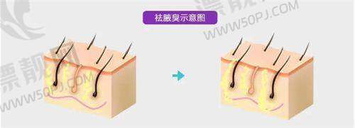 佛山曙光金子医院筋膜提升价格参考