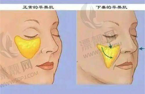 吸脂塑形项目价格与优势