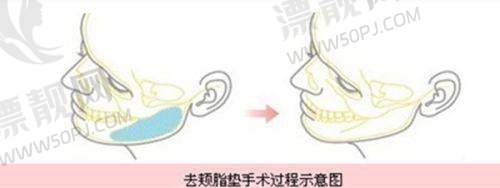 影响生长因子填充面部维持时间的关键因素