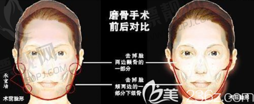 三、选择Neli无针吸脂机构的注意事项