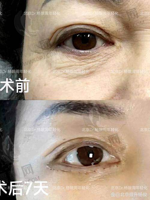 技术盘点：4D动态重睑线+自然分离组织技术
