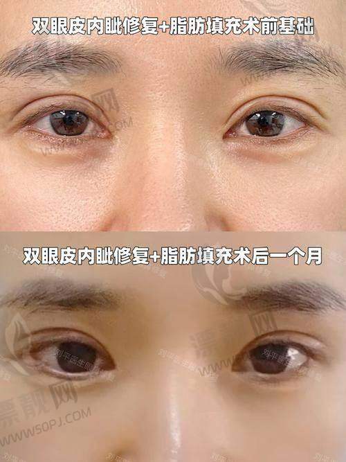 术后修复快！实例分析来一波