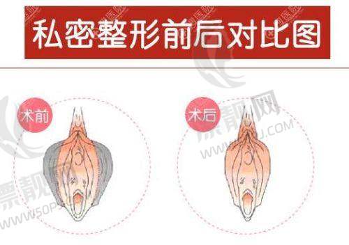 项目做完后多久见效？成效能维持多久？