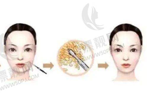 术后成效对比:两种风格任君选择