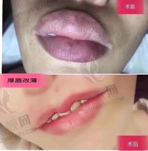 第一名:郑美善院长(韩国蜡笔Crapas整形外科)