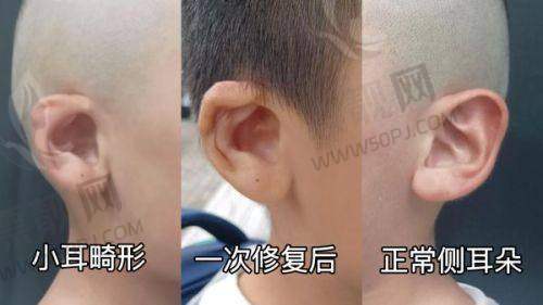 修复周期对比:微针速度更快