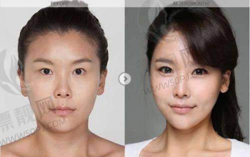 手术费用情况如何?