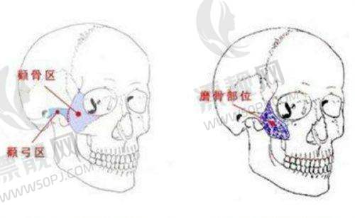与恒久性填充剂对比:可逆性与低风险的优势