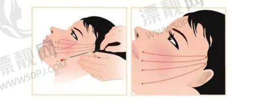 太原紧缩针医生排名