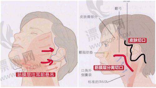 二、丰胸针一针管几年?
