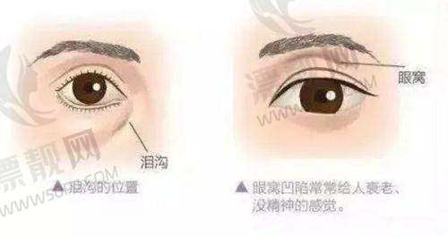 美诗沁微创去眼袋注意事项
