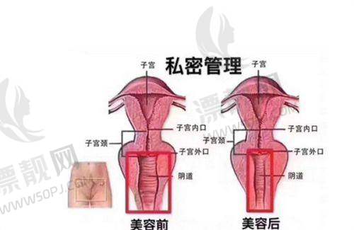 ADM - H内置生物套技术怎么样靠谱吗？费用、延时效果、是否永久及安全性全揭秘