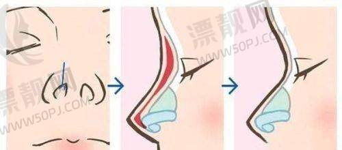 两种注射的术后护理要点