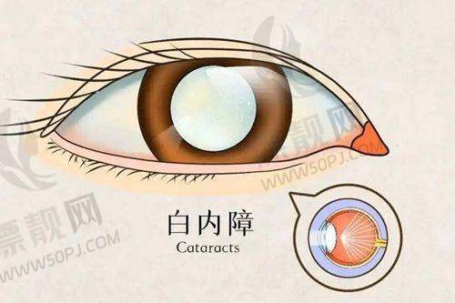 赣州白内障手术免费政策新消息公布，申请条件、步骤大揭秘，错过或自费8000元手术费！
