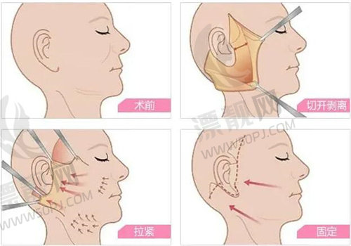 2025 北京筋膜提升好的医院排名揭秘！各院优势大公开，谁是你的心头好？
