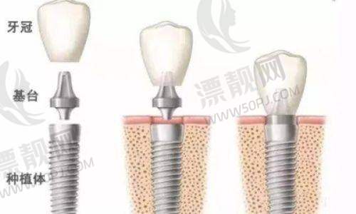 一句话结论：可以放心种、可以安心矫、可以大胆拔~