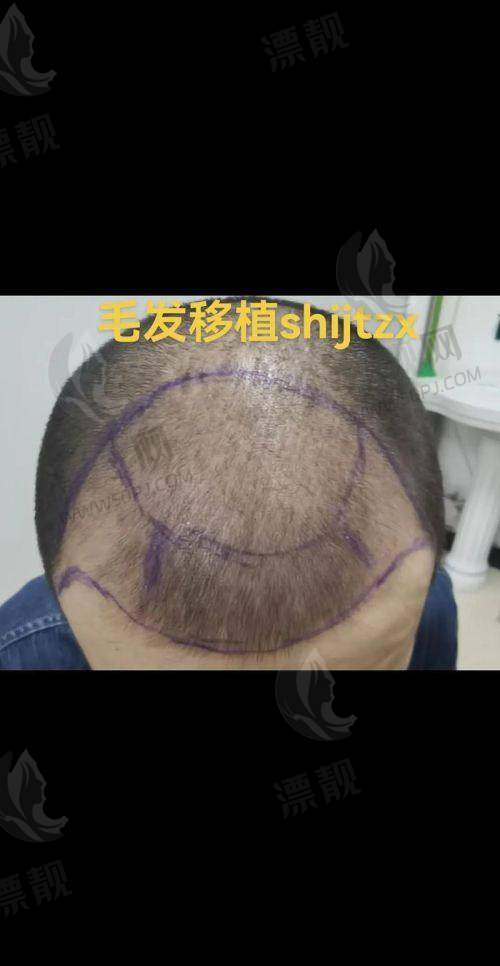 成都植发医院还有这些值得探访机构（排名11-20）