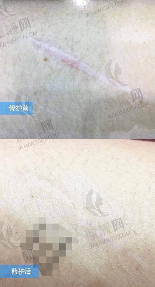 门诊实情：疤痕修复还得看医生+设备综合实力