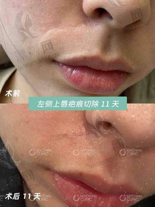 不同疤痕修复方法对比及建议选择方式