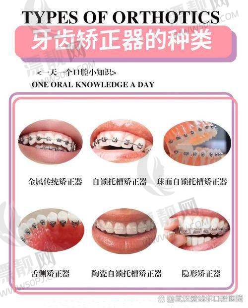 价格透明吗？种牙/矫正费用速览+适合人群指南