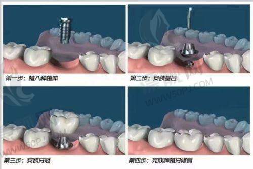宁远雅美康口腔价格透明？实际实例表格分析说话