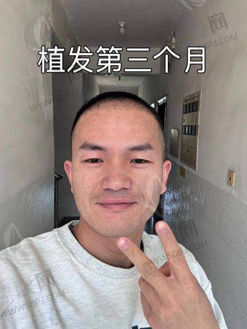TOP7：名韩植发