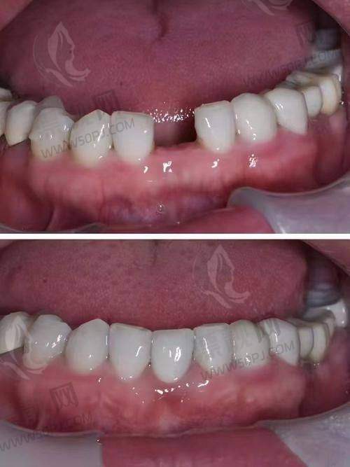 种牙不再迷茫：如何选择适合自己的口腔医院？