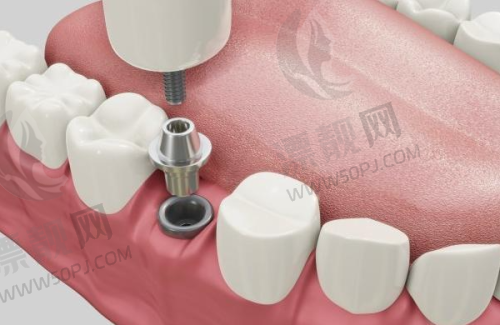 贵阳华美口腔中心怎么样？新一代 all - on - 4 技术 + 纳米材质种植体，优势大揭秘！