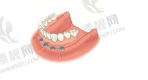 4. 合肥中诺口腔——临床经验多，数字化导板种植