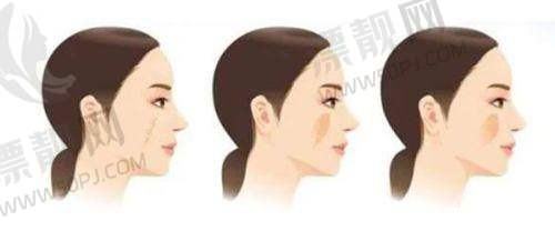 上海薇琳医疗美容医院:张怀军 医生的吸脂魔法